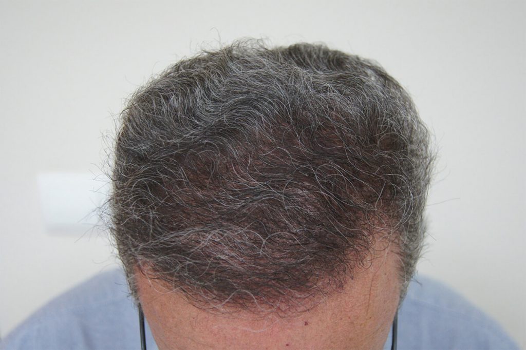 final outcome of hair transplantation with FUT
