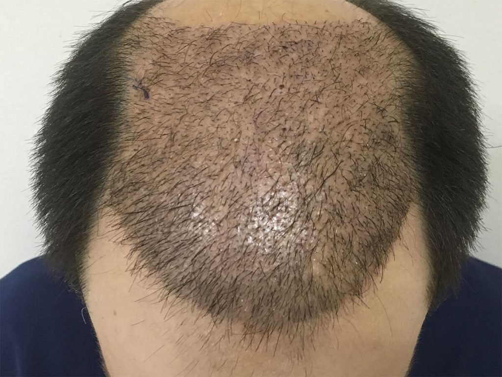 Final result after FUT hair transplantation