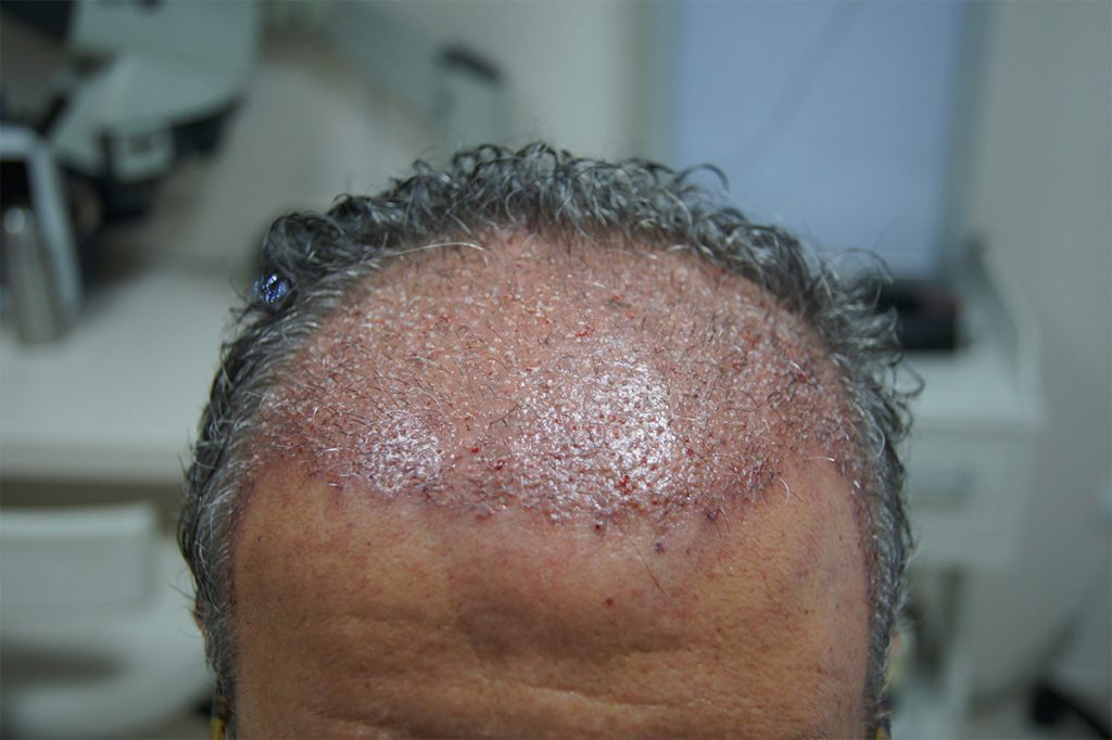 first results of FUT hair transplantation