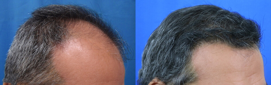FUT hair transplantation side view before and after