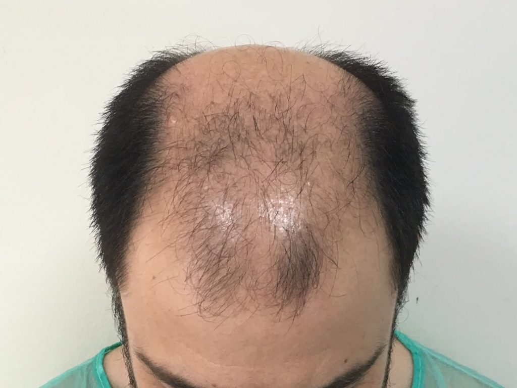 hair transplantation scalp image before FUT