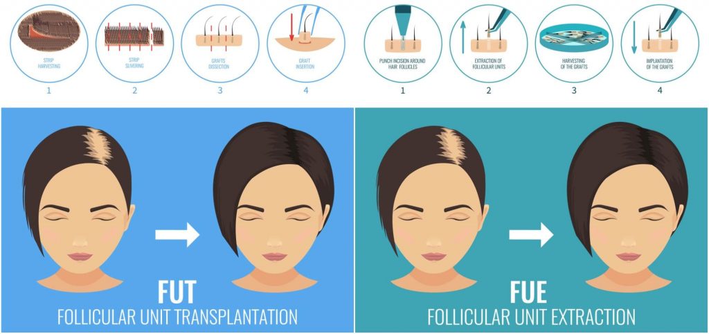 FUT and FUE hair transplantation techniques in women