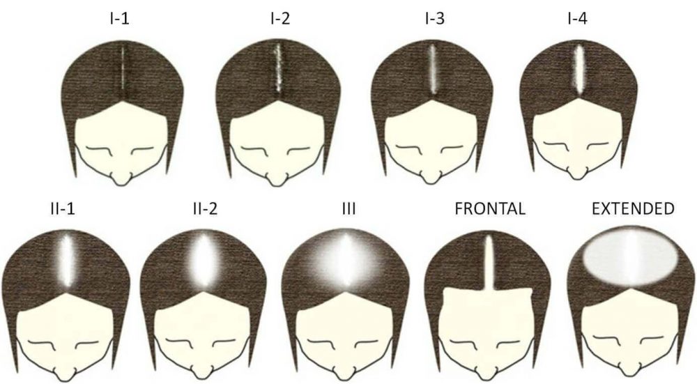 Hair Loss In Women Ht Results Anastasakis Hair Clinic