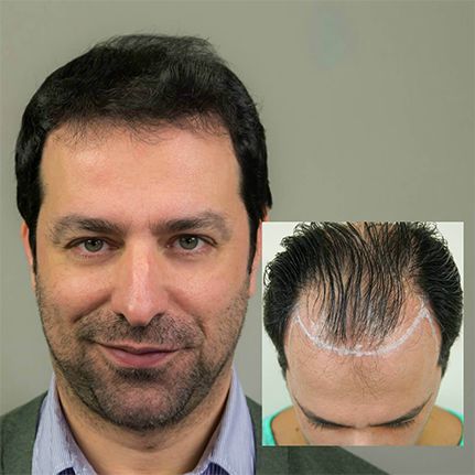 Hair Transplantation In Greece Anastassakis Hair Clinic